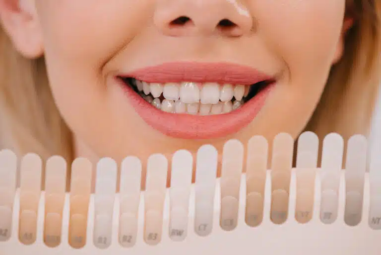 What is the Procedure for Dental Veneers