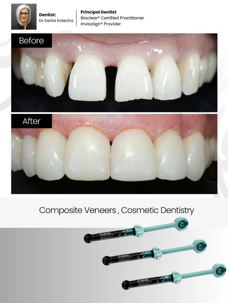 dental veneers london at smile cliniq