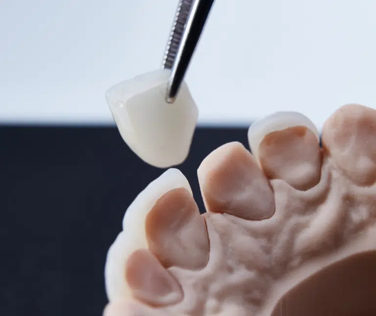 dental veneers london dentists smile cliniq