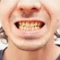 treating discoloured teeth with composite bonding thumbnail