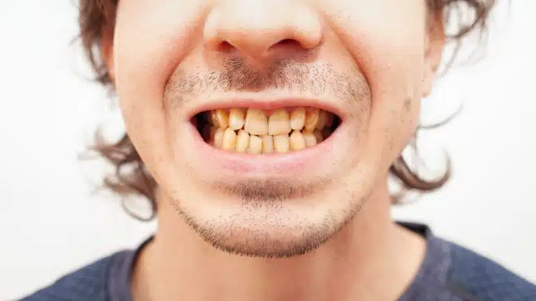 treating discoloured teeth with composite bonding