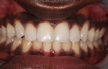  Diastema Closure after