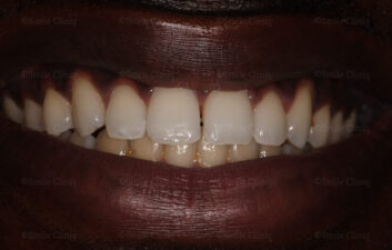  Diastema Closure Before