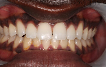  Diastema Closure Before