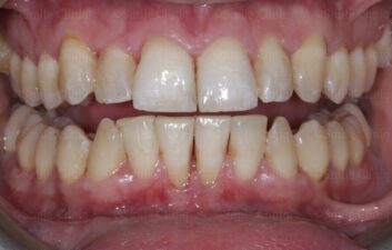 Periodontal treatment and anterior fillings After