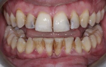  Periodontal treatment and anterior fillings Before