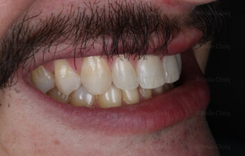 Smile after upper invisalign 