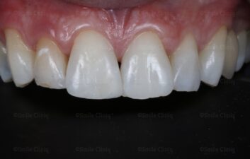  Whitening And Bondong After 