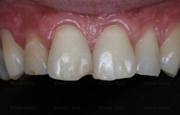 Whitening And Bondong Before 