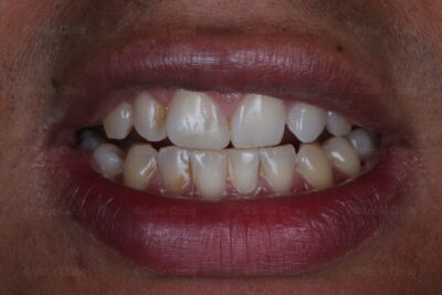 Emergency Dentist London Broken Tooth After