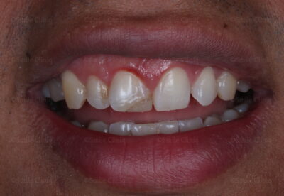 Emergency Dentist London Broken Tooth Before