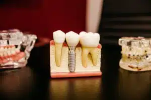 dental implants