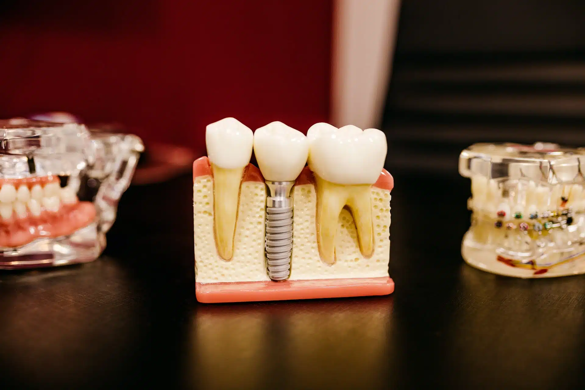 5 reasons to consider dental implants thumbnail