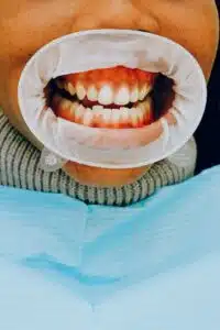 tooth gums