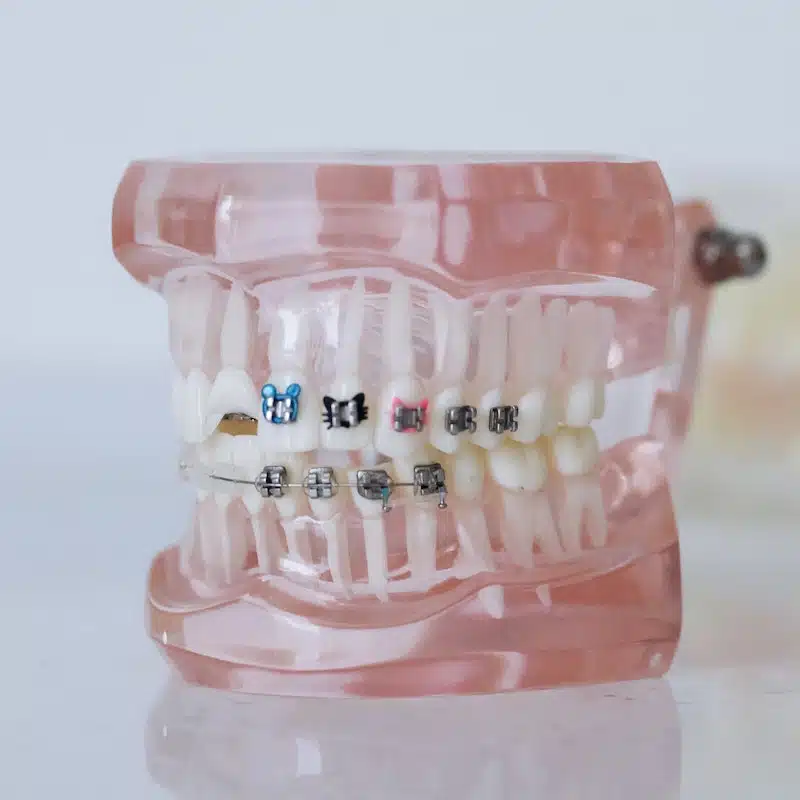 Flossing With Braces: Everything You Need to Know thumbnail