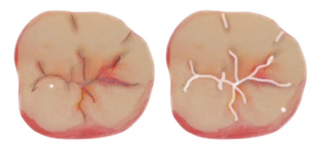 Diagram illustrating the application of Dental Fissure Sealant