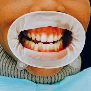 patient wearing a dental cheek retractor