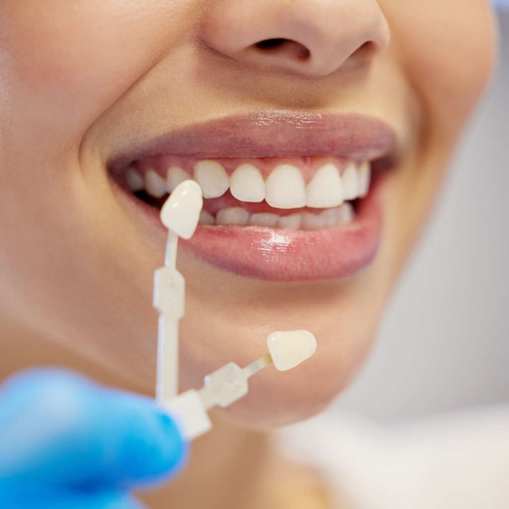 a woman being fitted with veneers