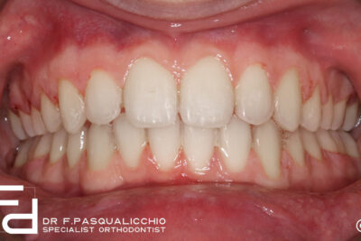 Carriere - motion - appliance - overbite correction - after