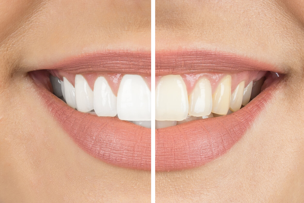 comparing white and stained teeth
