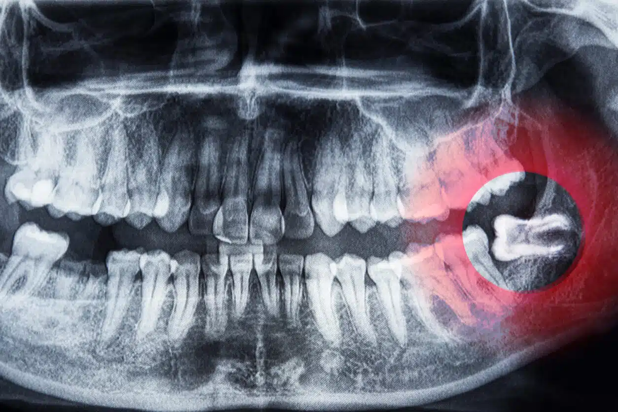 wisdom tooth