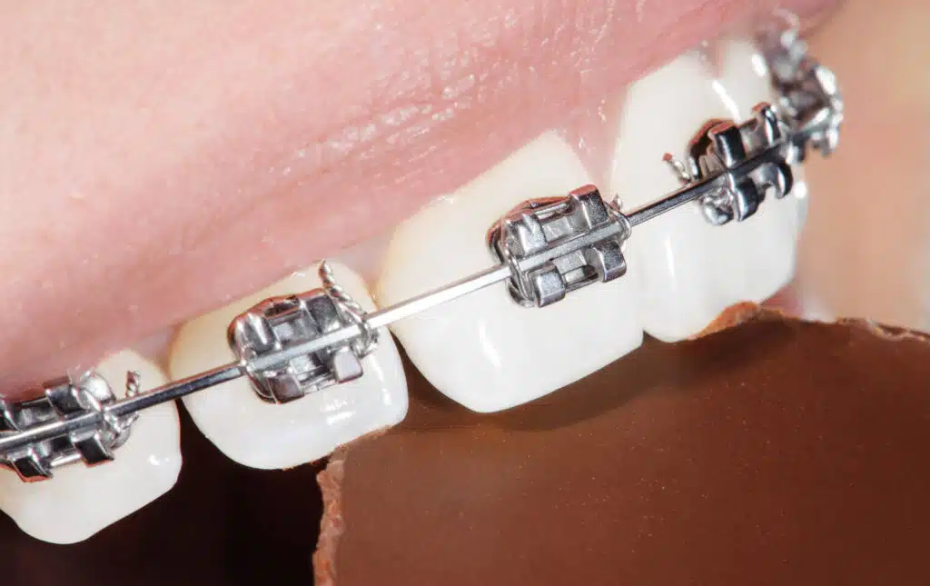 Benefits of Fast Braces