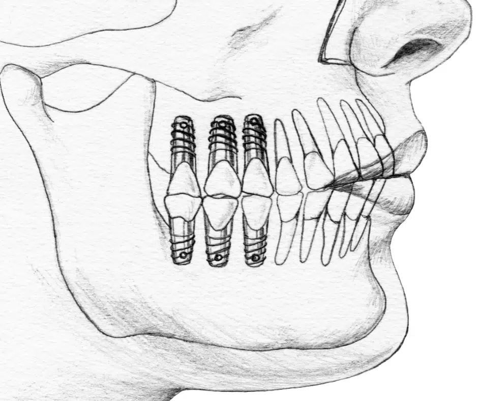 ceramic_dental_implant_london