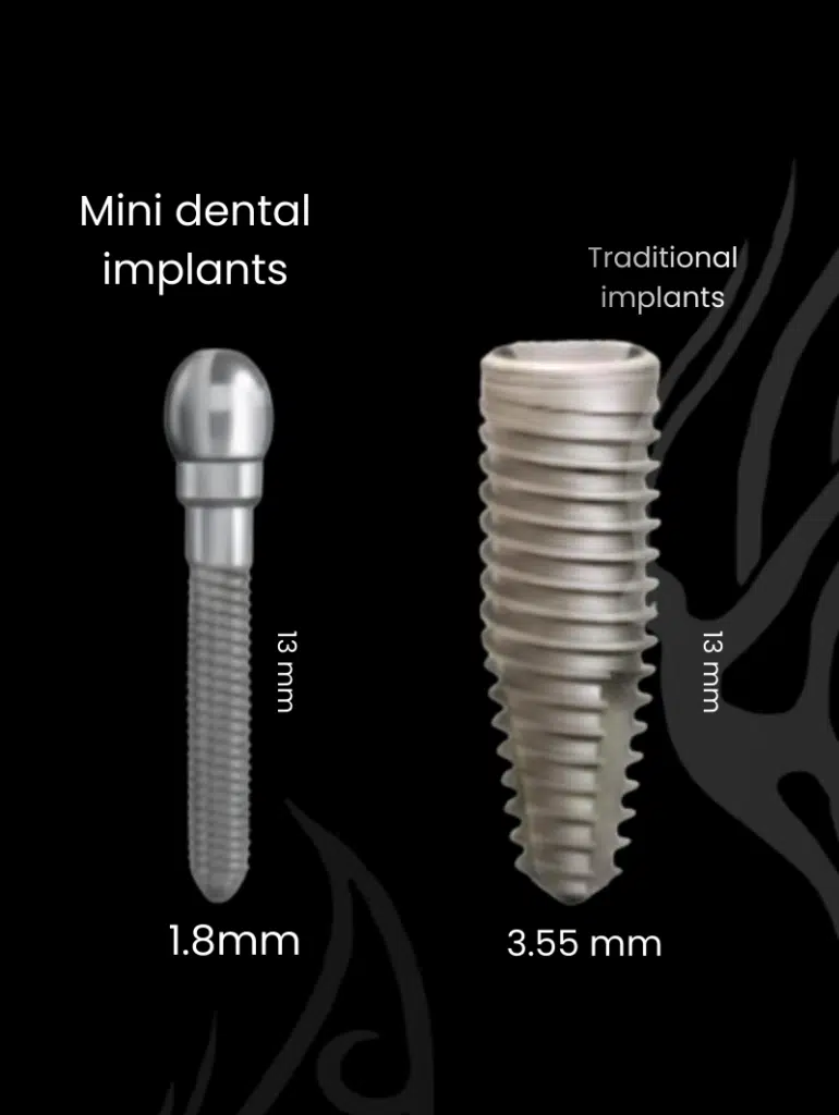 dental implants london 6