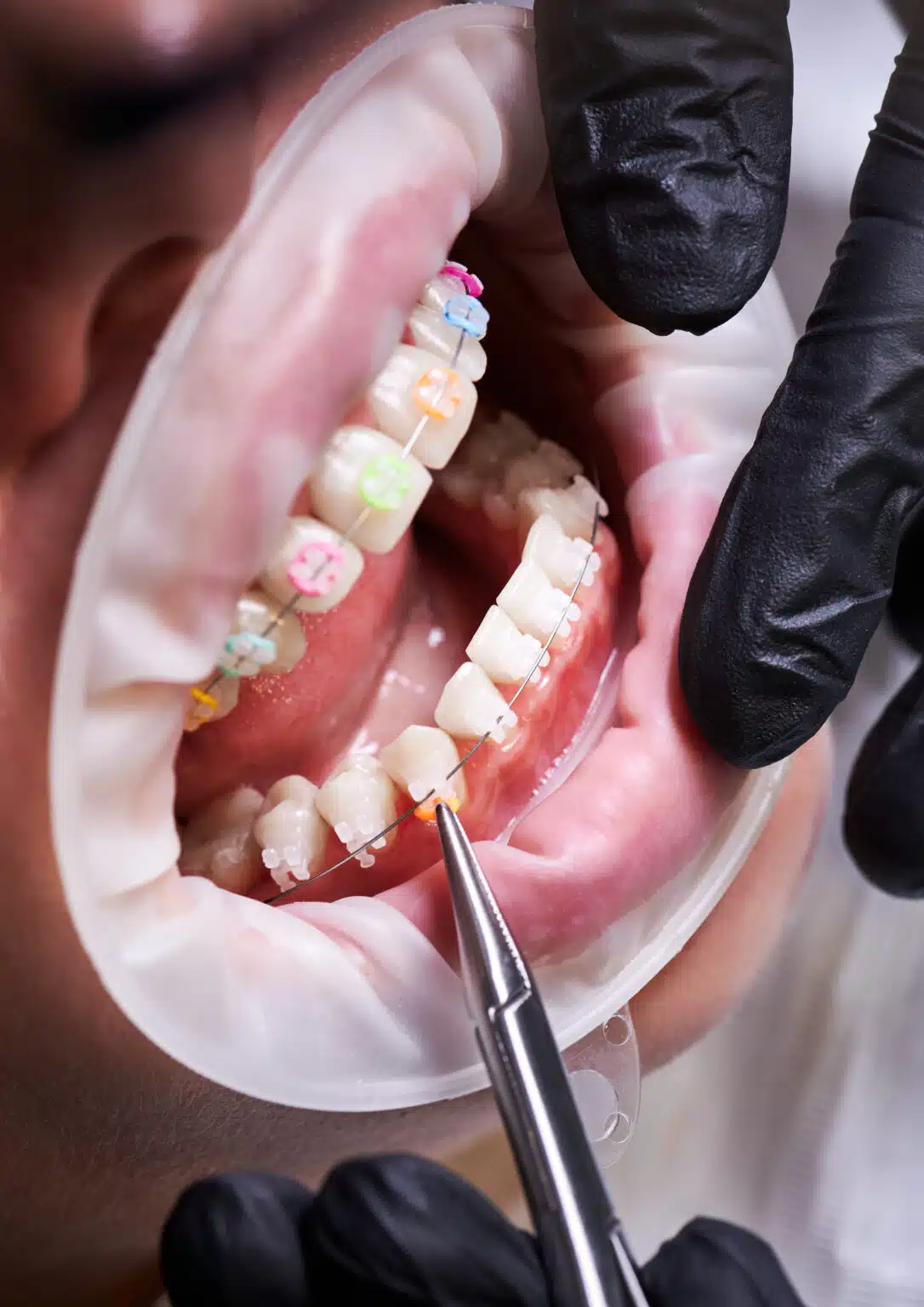 Have Damon Braces