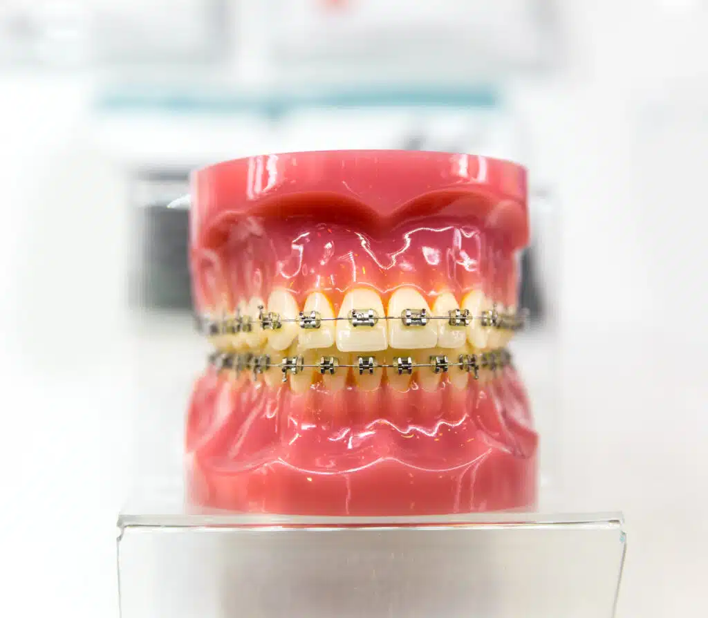 How does Fastbraces work