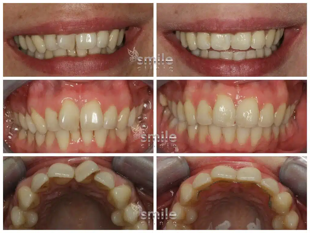 Orthodontic Before And After: Multiple Views Of Teeth Significantly Straightened And Aligned. orthodontic before and after: multiple views of teeth significantly straightened and aligned.