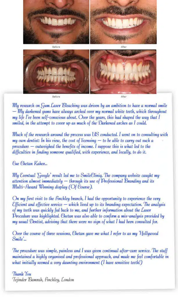 man's smile and gums transformed by laser bleaching; before/after comparison with testimonial.