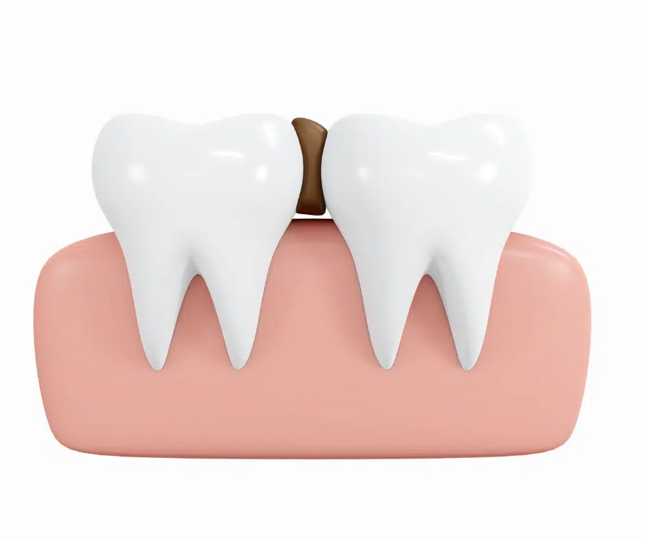 gum disease caused by plaque