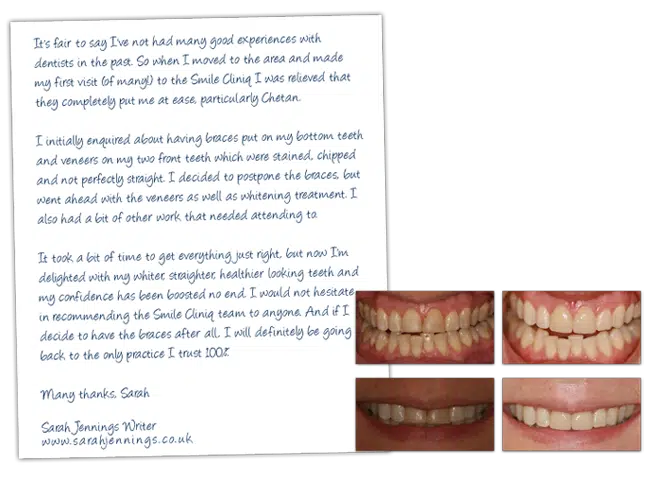 woman's smile transformation: misaligned teeth become straight, bright after dental treatment.