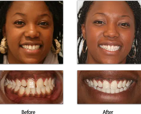 woman's before and after photos showcasing straightened and improved teeth from dental treatment.
