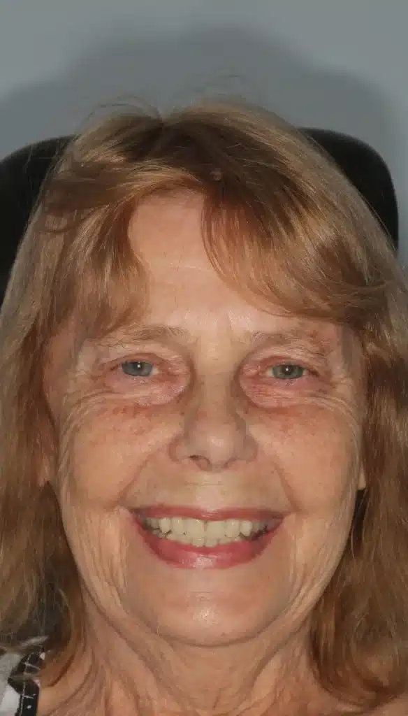 all on 4 dental implants after