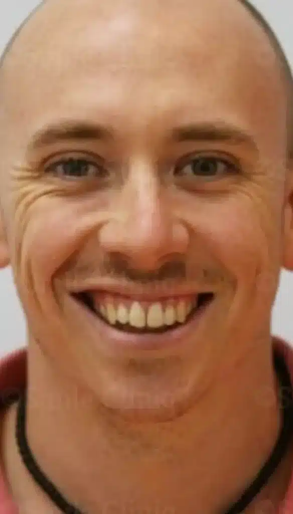 dental veneers after