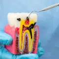 what happens inside a root canal: a step-by-step look at endodontic treatment in finchley thumbnail
