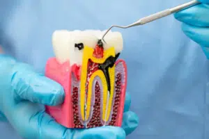 endodontics treatments