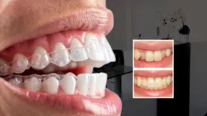 invisible braces