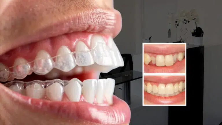 invisible braces