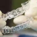 invisalign attachments and ipr explained: why your clincheck isn’t the full picture thumbnail