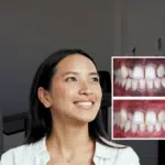 gum depigmentation