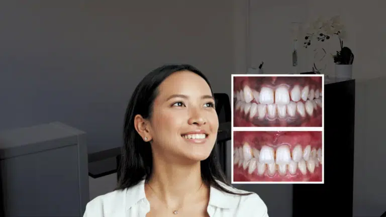 gum depigmentation