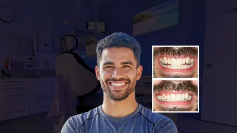 gum recession