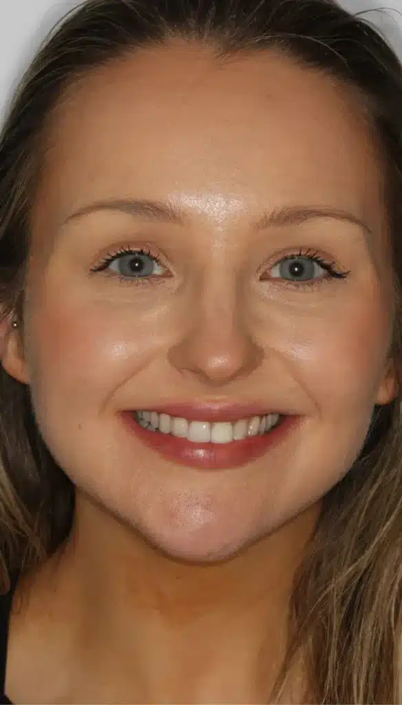 invisalign london after