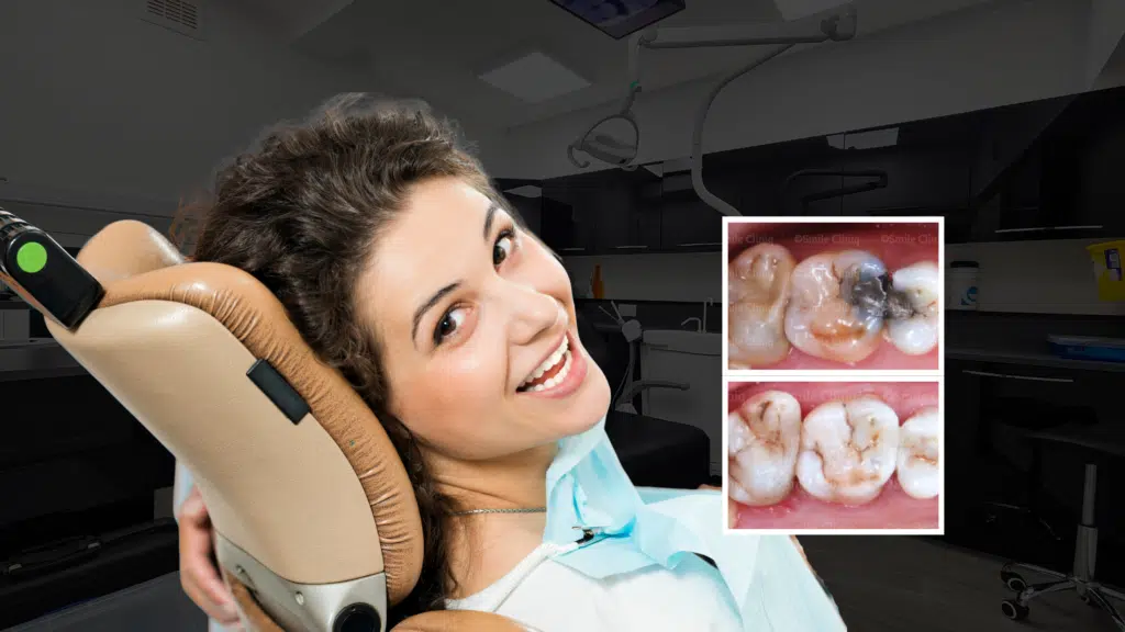 Patient smiling in the dental chair after mercury amalgam removal